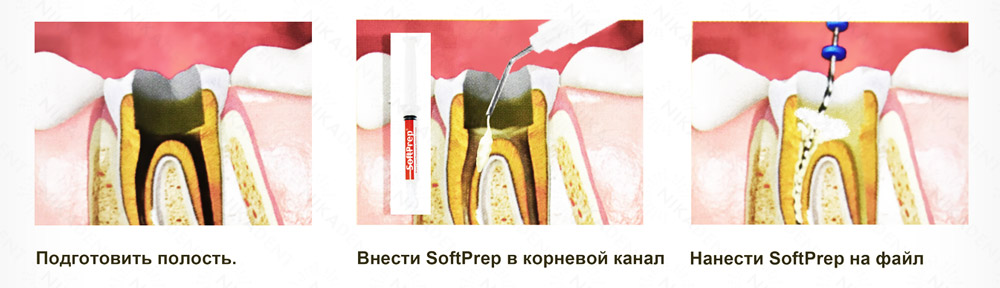 SoftPrep гель ЭДТА 17% SoftPrep гель ЭДТА 17%