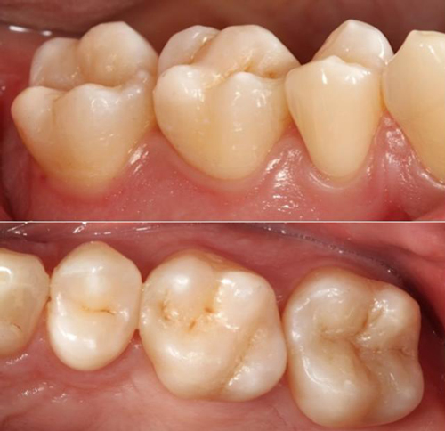 ceram.x SphereTEC Dentsply ceram.x SphereTEC Dentsply