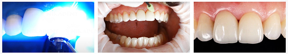 Variolink Esthetic LC, инструкция по применению Variolink Esthetic LC, инструкция по применению