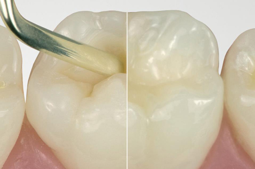 ceram.x SphereTEC Dentsply ceram.x SphereTEC Dentsply
