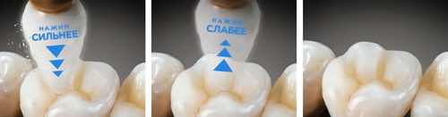 Enhance Dentsply Enhance Dentsply