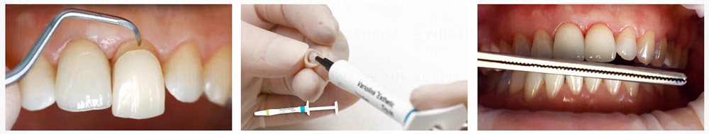 Variolink Esthetic LC, инструкция по применению Variolink Esthetic LC, инструкция по применению