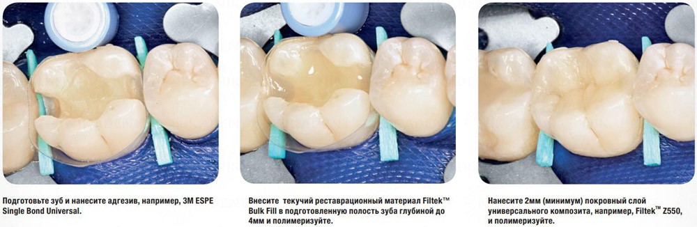Filtek Bulk Fill прокладочный стоматологический материал с возможностью объемного внесения. Filtek Bulk Fill прокладочный стоматологический материал с возможностью объемного внесения.
