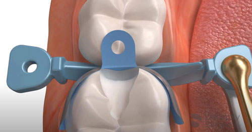 Матрицы Palodent Dentsply Матрицы Palodent Dentsply