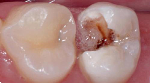 Однослойная реставрация с Herculite Ultra однослойная реставрация. Однослойная реставрация с Herculite Ultra однослойная реставрация.