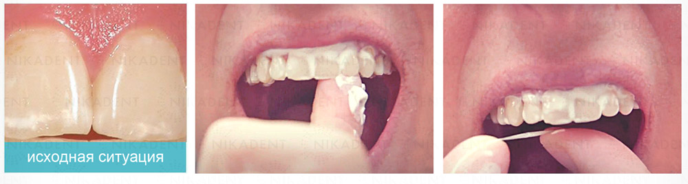 Tooth Mousse гель с био-доступными кальцием и фосфатом для реминерализации эмали и восстановления минерального баланса в полости рта Tooth Mousse гель с био-доступными кальцием и фосфатом для реминерализации эмали и восстановления минерального баланса в полости рта
