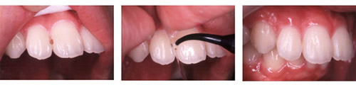 Gradia-Direct-Flo Gradia-Direct-Flo