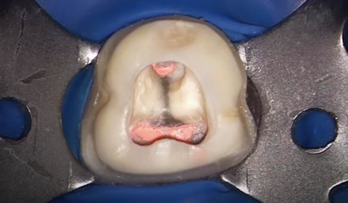 Обтураторы Thermafil Dentsply